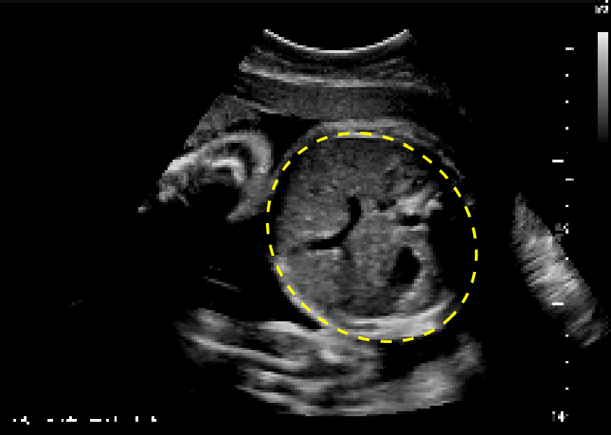 Automatic Estimation of Fetal Abdominal Circumference from Ultrasound
