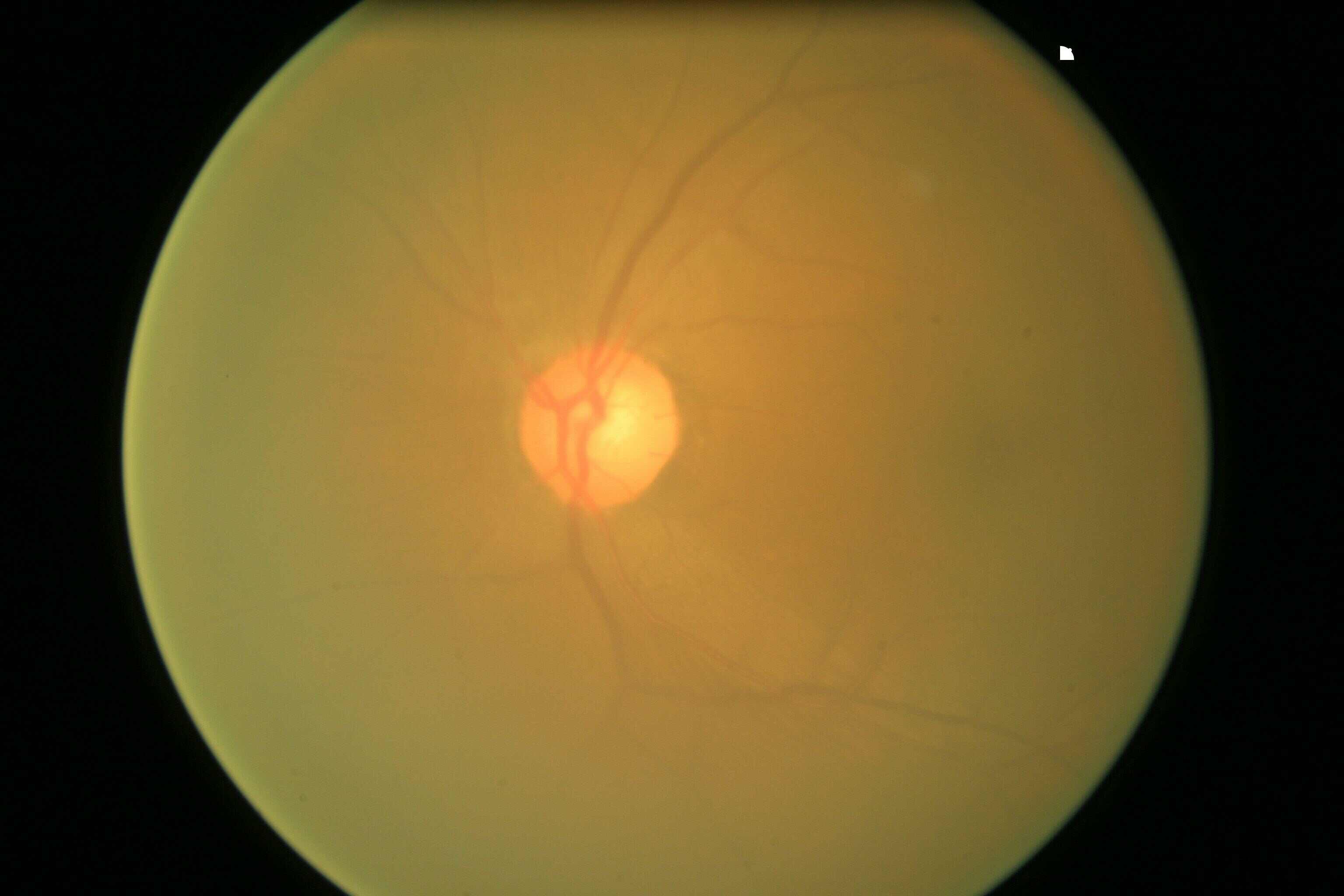 Structurepreserving Guided Retinal Image Filtering and Its Application