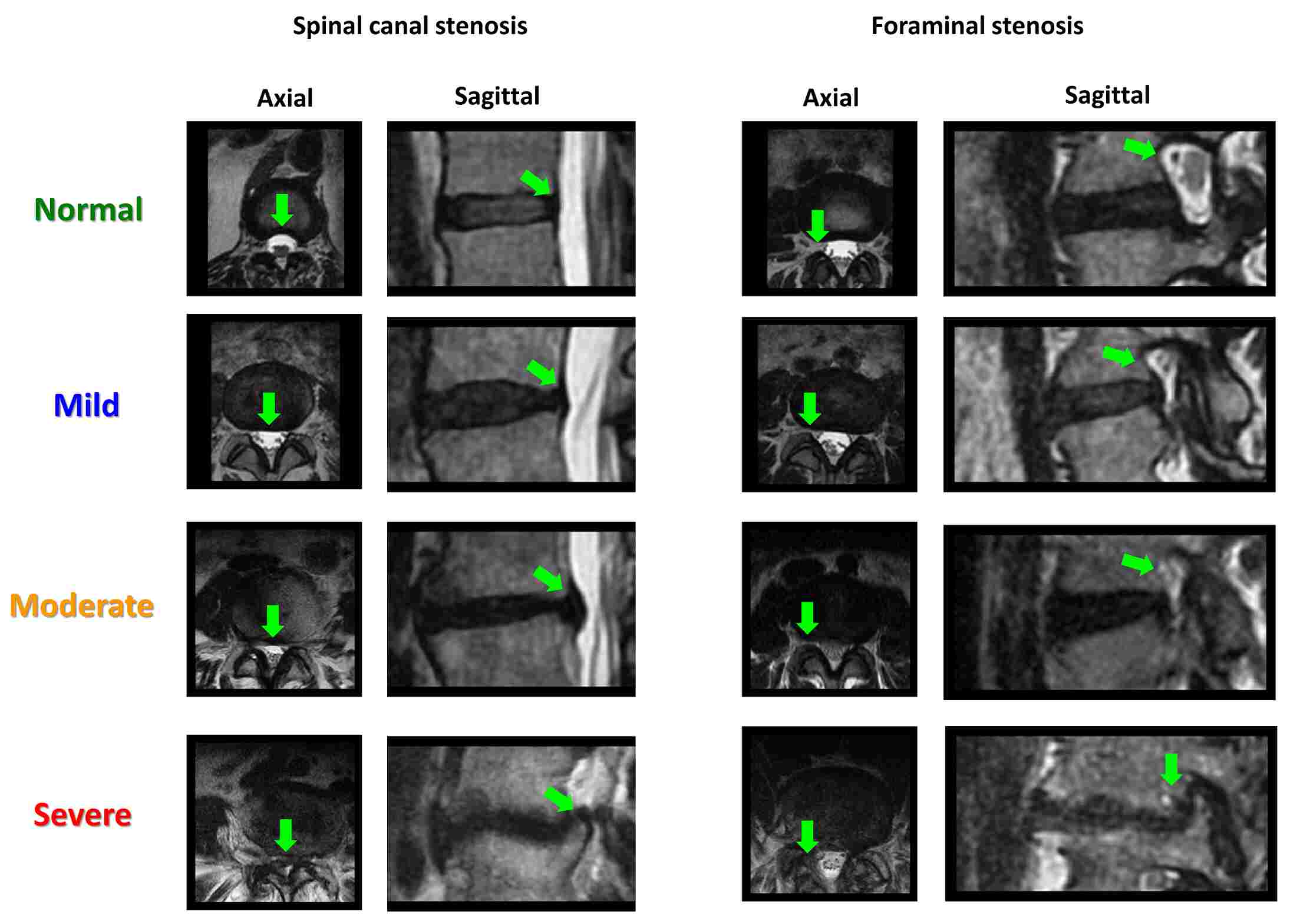 Lumbar Stenosis Grading