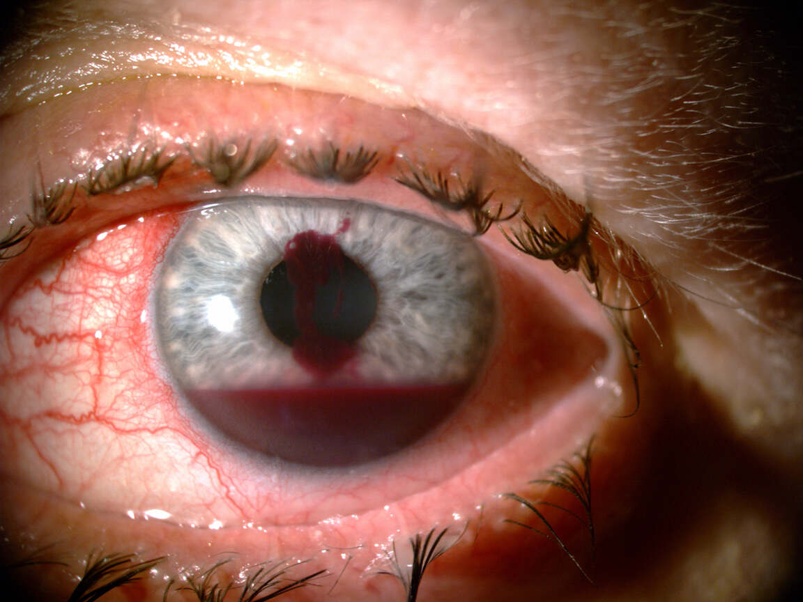 Implications of Ocular Pathologies for Iris Recognition Reliability