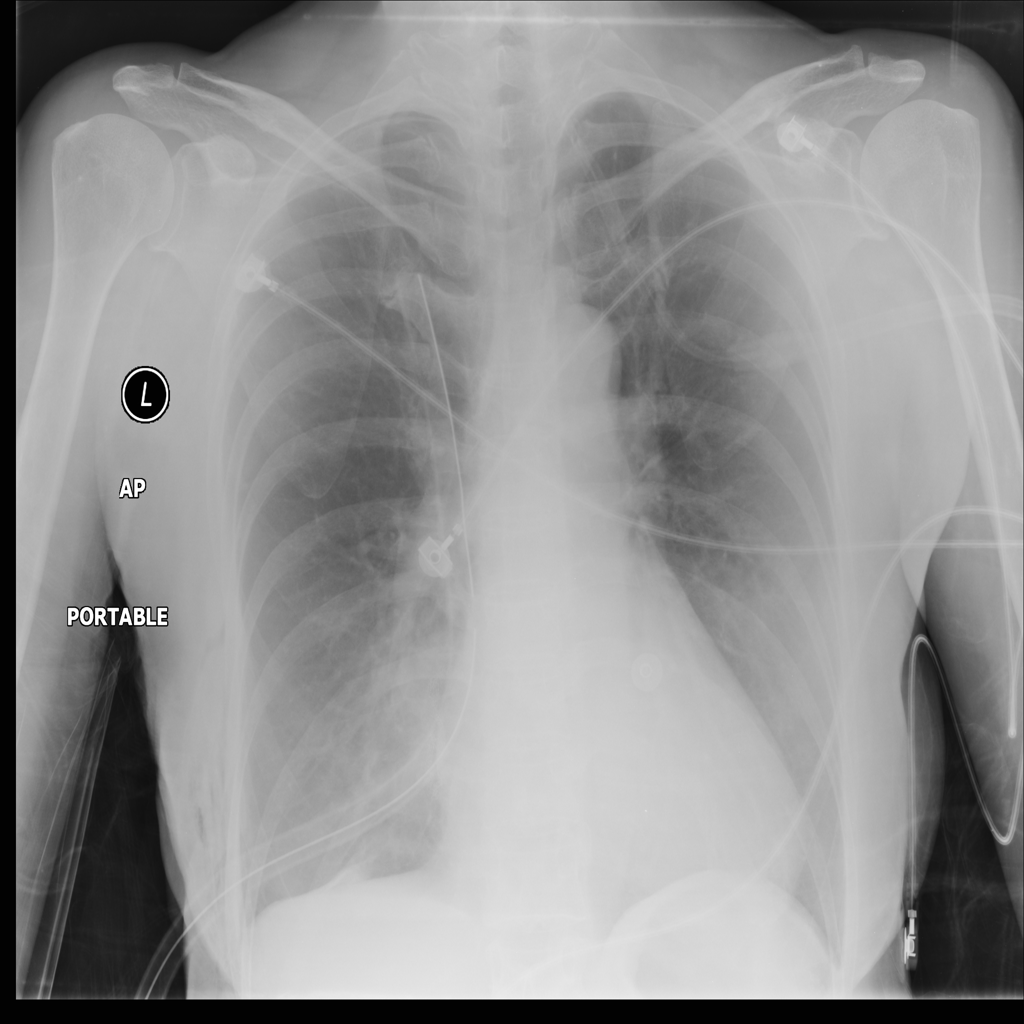 Identifying diseasefree chest Xray images with deep transfer learning