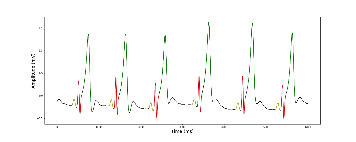 Deep Learning for ECG Segmentation | DeepAI
