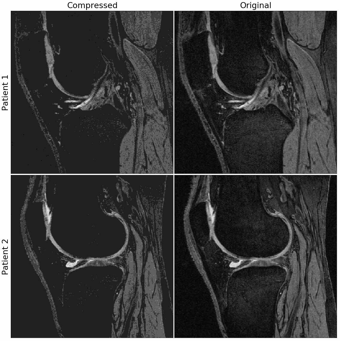Deep learning predicts total knee replacement from resonance images DeepAI
