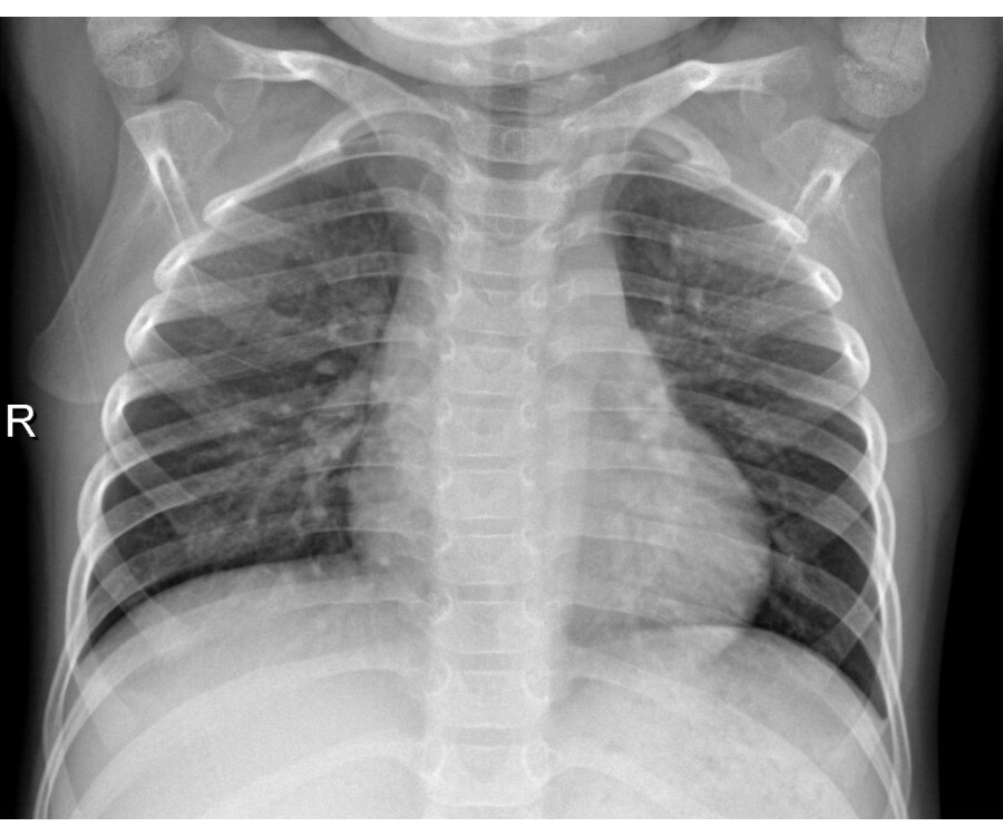 Classification of pediatric pneumonia using chest Xrays by functional