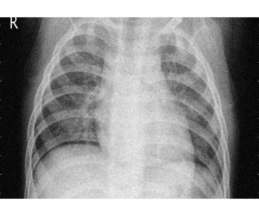 Classification of pediatric pneumonia using chest Xrays by functional