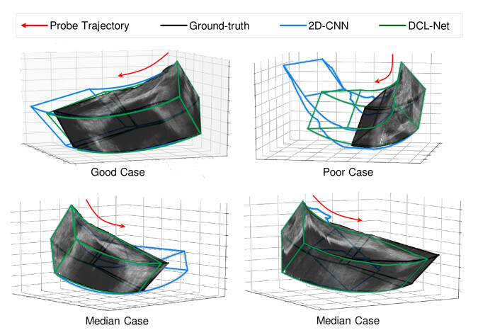 Sensorless Freehand 3D Ultrasound Reconstruction via Deep Contextual ...