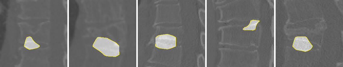 Interpretable Vertebral Fracture Diagnosis | DeepAI