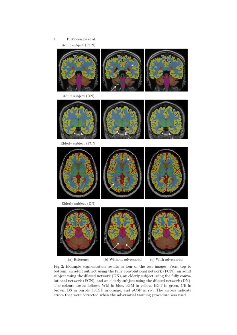Adversarial training and dilated convolutions for brain MRI ...